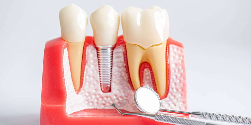 Implants dentaires Saint-Lazare